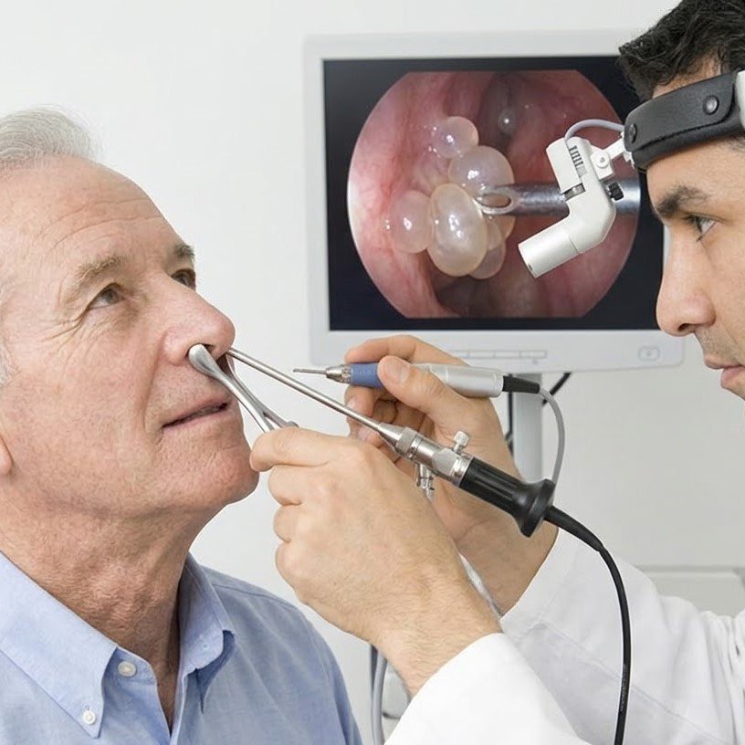Nasal Polyp