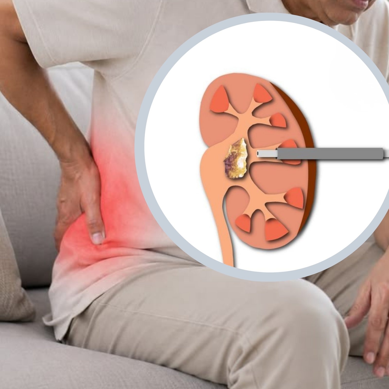 PCNL kidney stone surgery