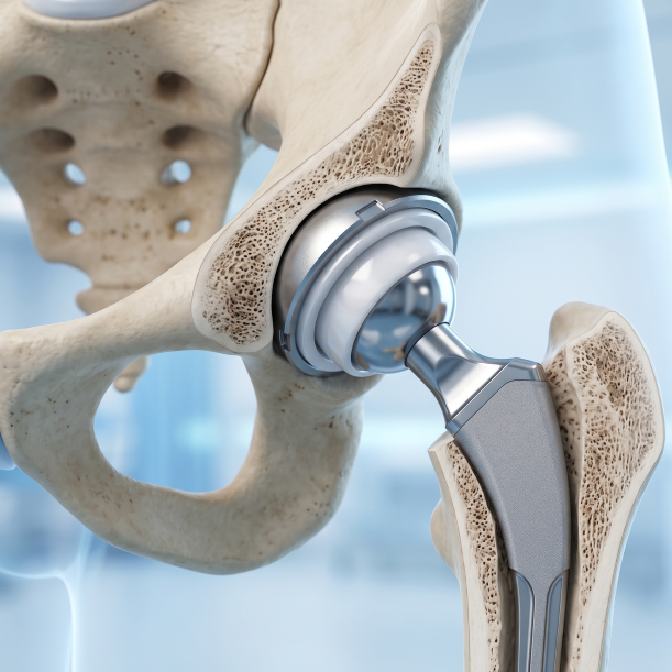 joint replacement