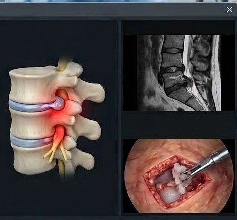 Lumbar Disc Herniation Repair