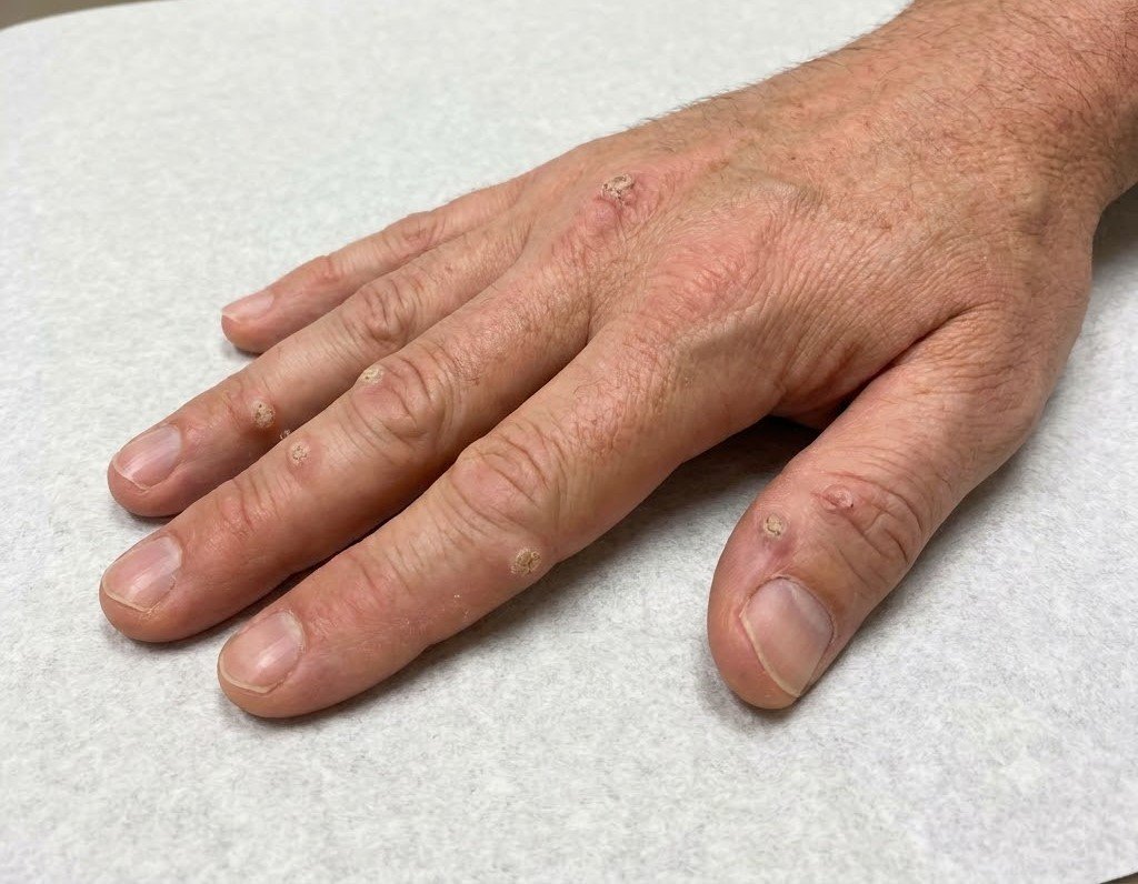 Wart & Lesion Removal